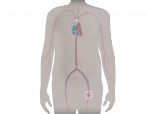 TAVI procedure step 1