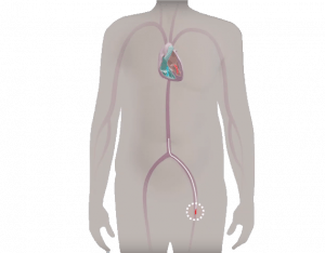 TAVI procedure step 2