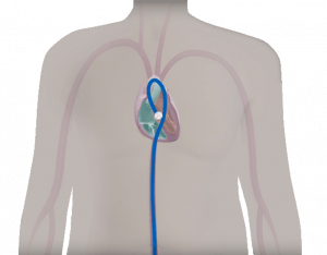 TAVI procedure step 4